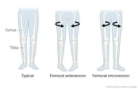 femoral torsion positive test|femoral anteversion in children.